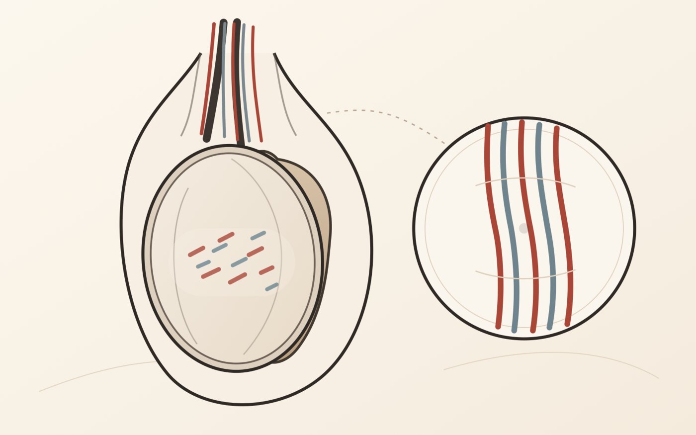 Desenho do testículo e do epidídimo com o plexo venoso do cordão espermático ao lado, mostrando a rede de veias que se dilata na varicocele.